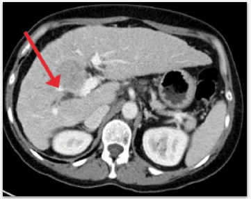 Projeto Detecção de Lesões Hepáticas