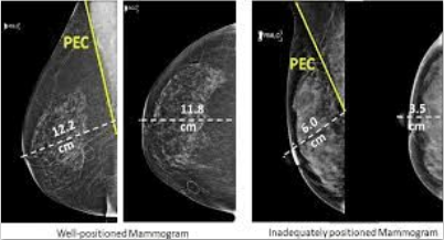 Projeto Posicionamento Mamografia